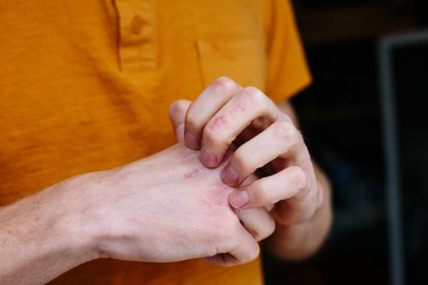 Cuáles son las alergias de otoño y cómo prevenirlas - Dermatitis atópica