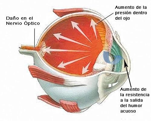 Cómo prevenir el glaucoma