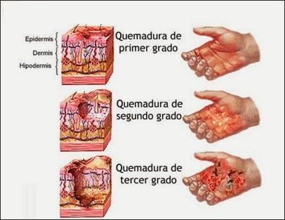 Cómo saber si una quemadura está infectada