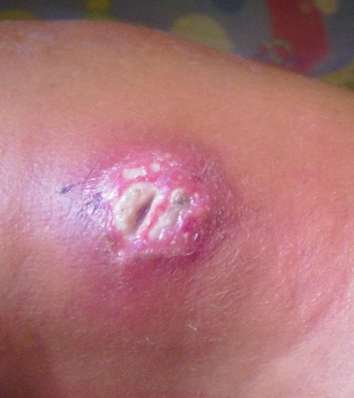 Cómo saber si una quemadura está infectada - Paso 3