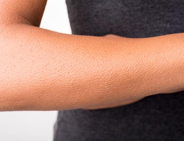 Cómo quitar la piel de gallina