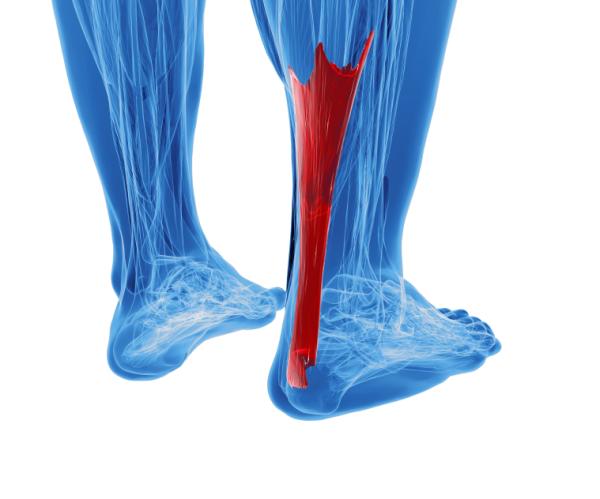 Síntomas de tendinitis en el pie - Qué es la tendinitis en el pie