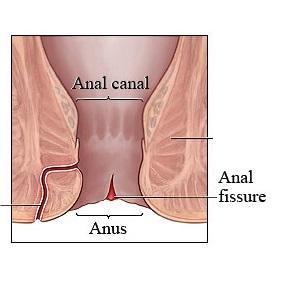 Cómo tratar la fisura anal - Paso 1