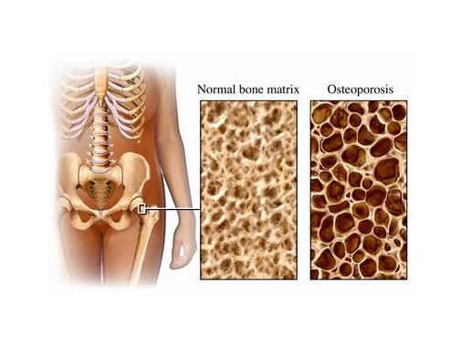 Cuáles son los factores de riesgo de la osteoporosis