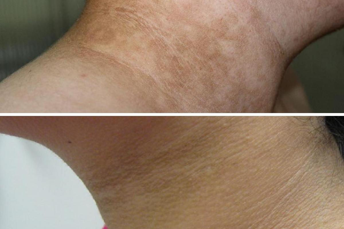 Cómo quitar lo negro del cuello