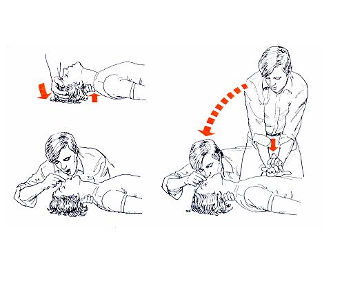 Cómo realizar una reanimación cardiopulmonar