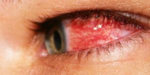 Cómo esterilizar ojos