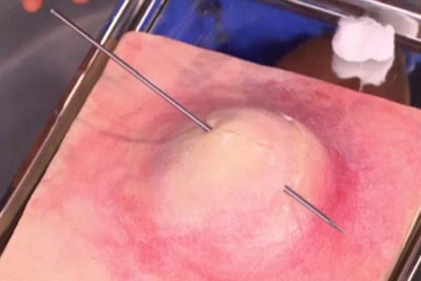 Cómo quitar un grano sin dejar marca - Paso 4