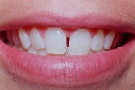 Qué es el diastema dental - Paso 1