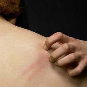 ¿Cómo dejar de rascarse la picazón?