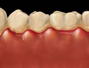 Por qué se inflaman las encías - Paso 1