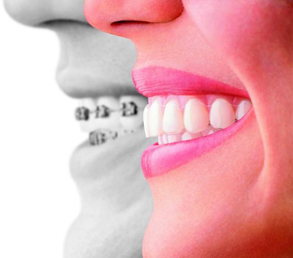 Por qué se inflaman las encías - Paso 2