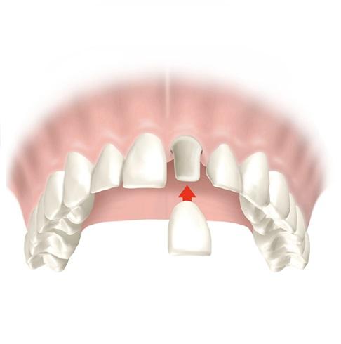 Por qué se inflaman las encías - Paso 3