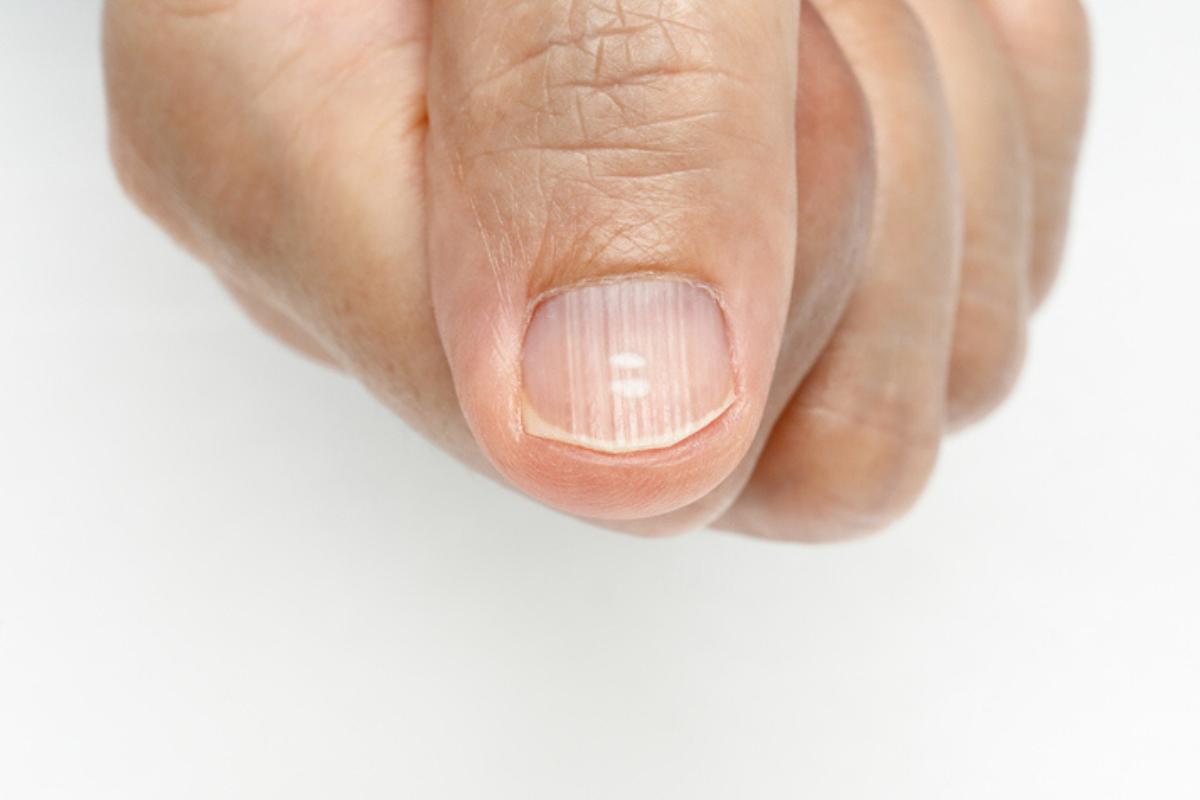 Rayas en las uñas: por qué salen y cómo eliminarlas - Descubre los motivos  y si hay que preocuparse