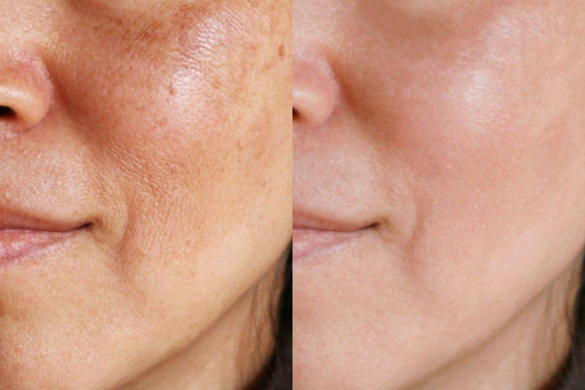 Para qué sirve el agua oxigenada en la cara y sus consecuencias