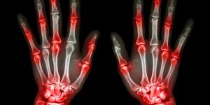 Cómo tratar la artritis reumatoide con hierbas