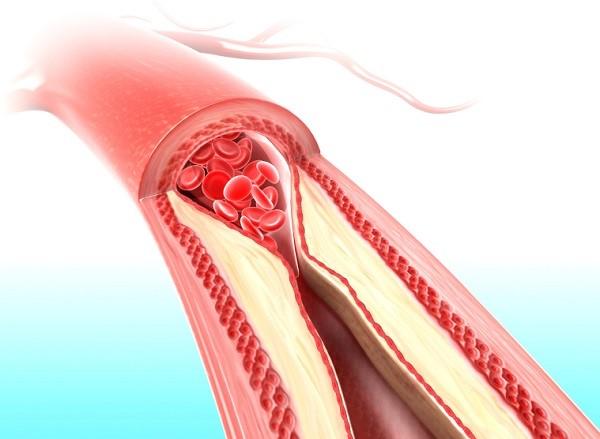 Para qué sirve el té rojo - Para reducir el colesterol