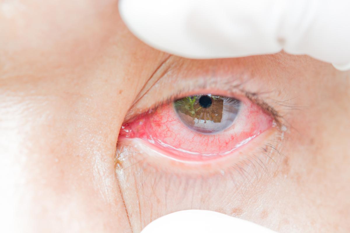 Cómo quitar la sensación de arena en los ojos