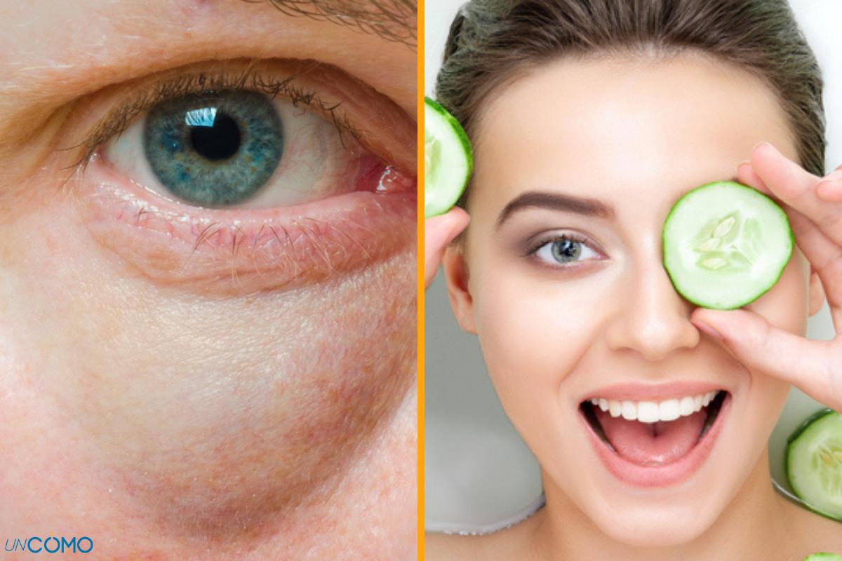 Remedios caseros para las bolsas en los ojos