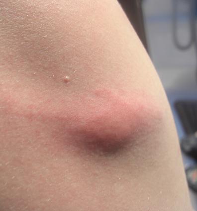 Cómo actuar frente a una picadura o mordedura