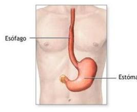 Cómo se manifiesta el espasmo esofágico difuso