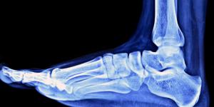 Cómo tratar los pies planos