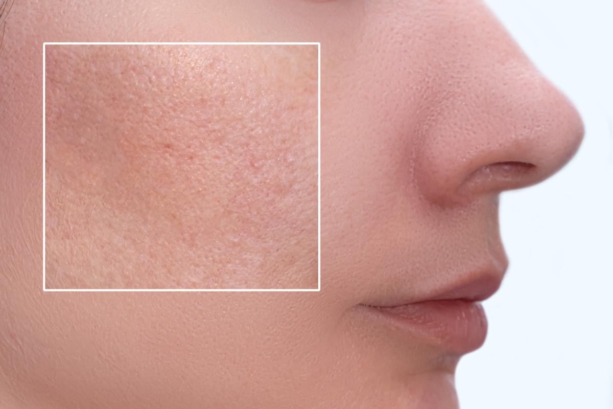 Cómo abrir los poros de la cara