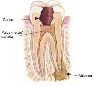 Por qué me duelen los dientes - Por qué me duelen los dientes: infecciones dentales 