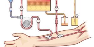Cómo funciona la diálisis