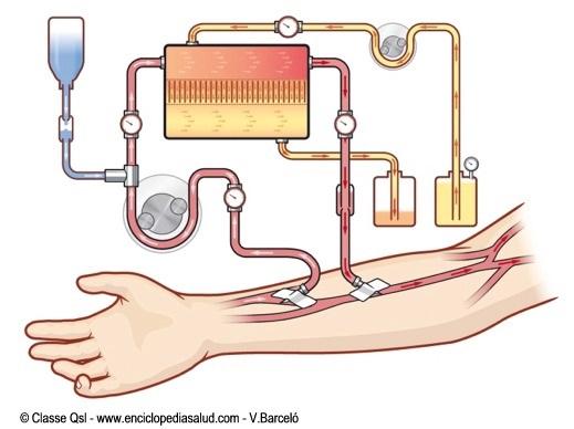Cómo funciona la diálisis