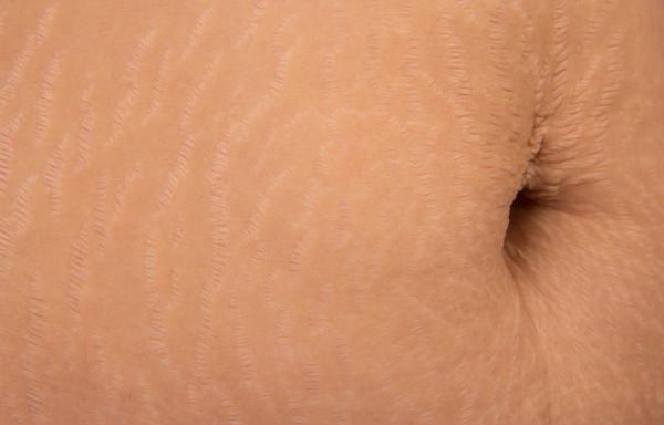 Remedios caseros para las estrías blancas