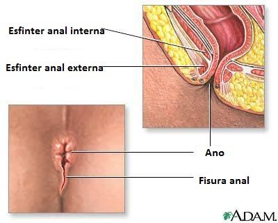 Cómo prevenir fisuras anales
