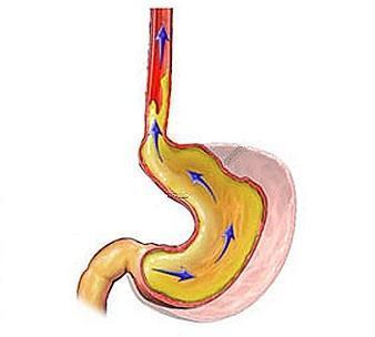 Cómo prevenir la enfermedad de reflujo gastroesofágico