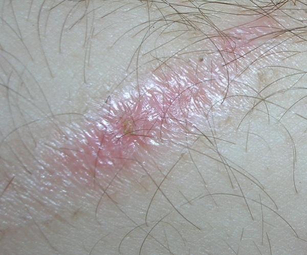 Cómo trasladar un niño con quemaduras graves