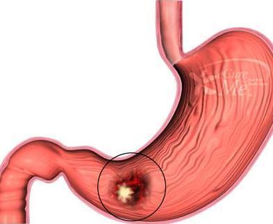 Cómo tratar el espasmo de estómago