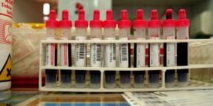 Cuáles son las causas de la fosfatasa alcalina baja