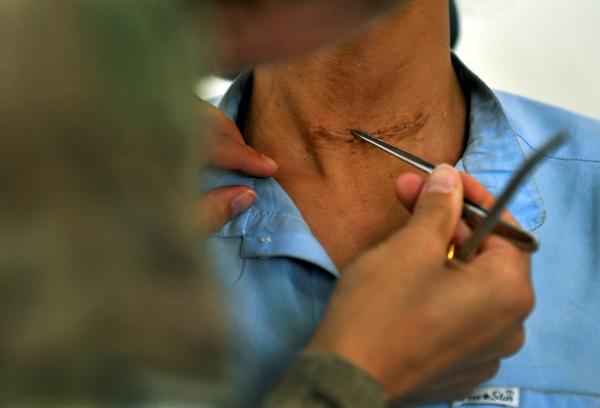 Cómo quitar puntos de sutura - Cómo quitar puntos de sutura - paso a paso