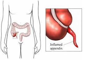 Cuáles son las causas de la apendicitis - Inflamación del apéndice