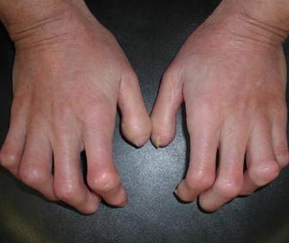 Cómo tratar la esclerodermia