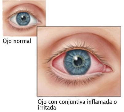 Por qué tengo los ojos rojos - Paso 4