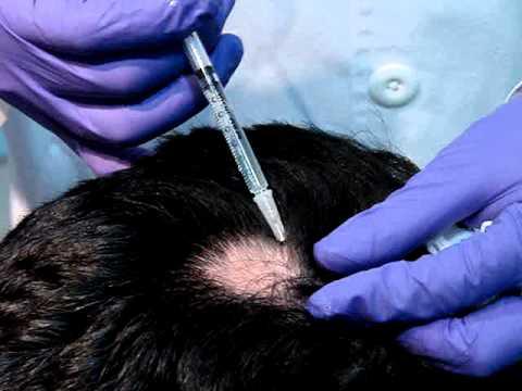 Cómo tratar la alopecia - Paso 3