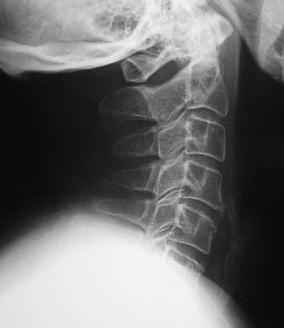 Cómo prevenir y aliviar el dolor de cervicales