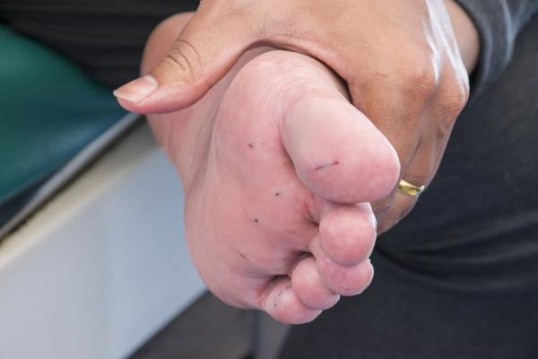 Picadura de erizo de mar: síntomas y cómo curarla