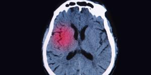 Cómo tratar un aneurisma