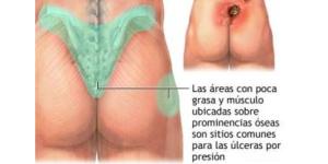 Cómo curar las escaras