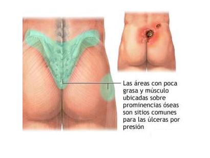 Cómo curar las escaras