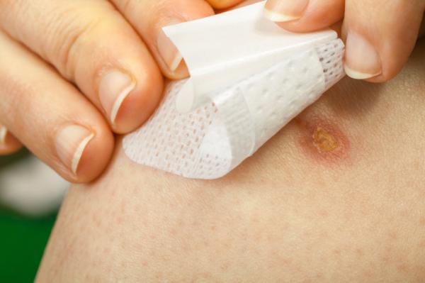 Cómo proteger una cicatriz del sol