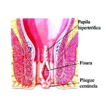 Cómo curar una fisura rectal - sin cirugia