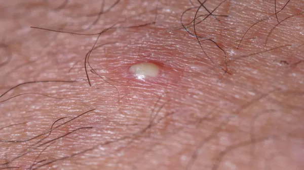 pelos encarnados vaginales infectados