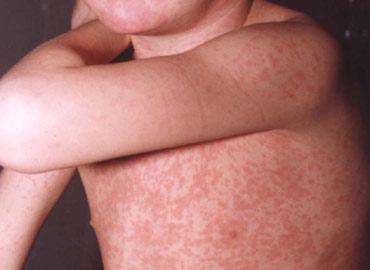 Cómo tratar la rubéola